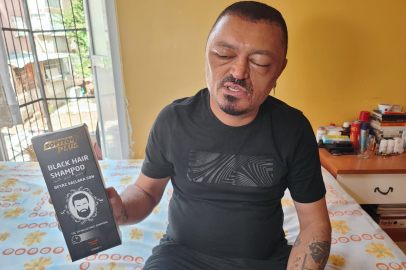 Saçlarını Siyahlatmak İçin Aldığı Şampuan Arı Sokmasından Beter Hale Getirdi