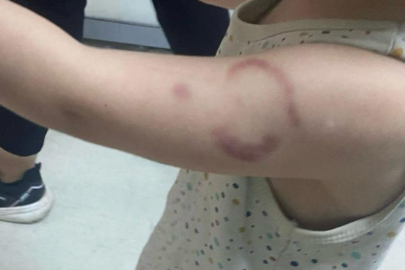 Edirne’yi Sarsan Olay: 3 Yaşındaki Çocuğu Öğretmeni Isırdı!