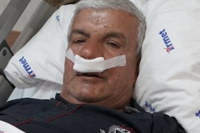 65 Yaşındaki Adamın Burnundan 100 Gramlık Taş Çıkarıldı